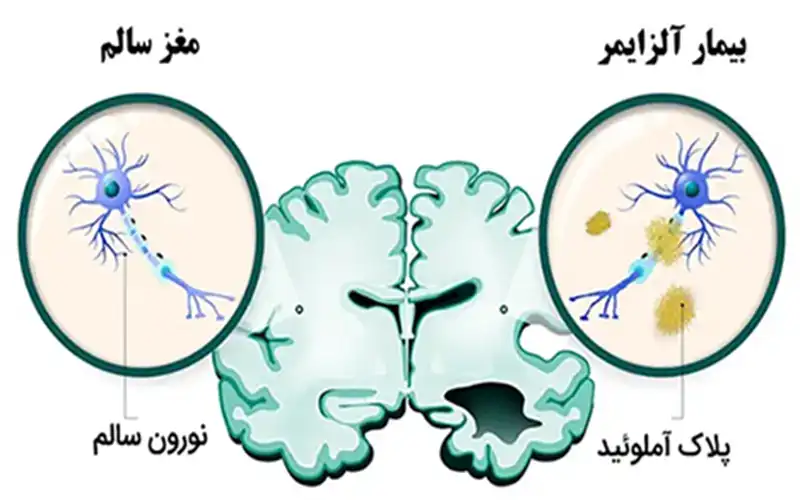 بیماری آلزایمر